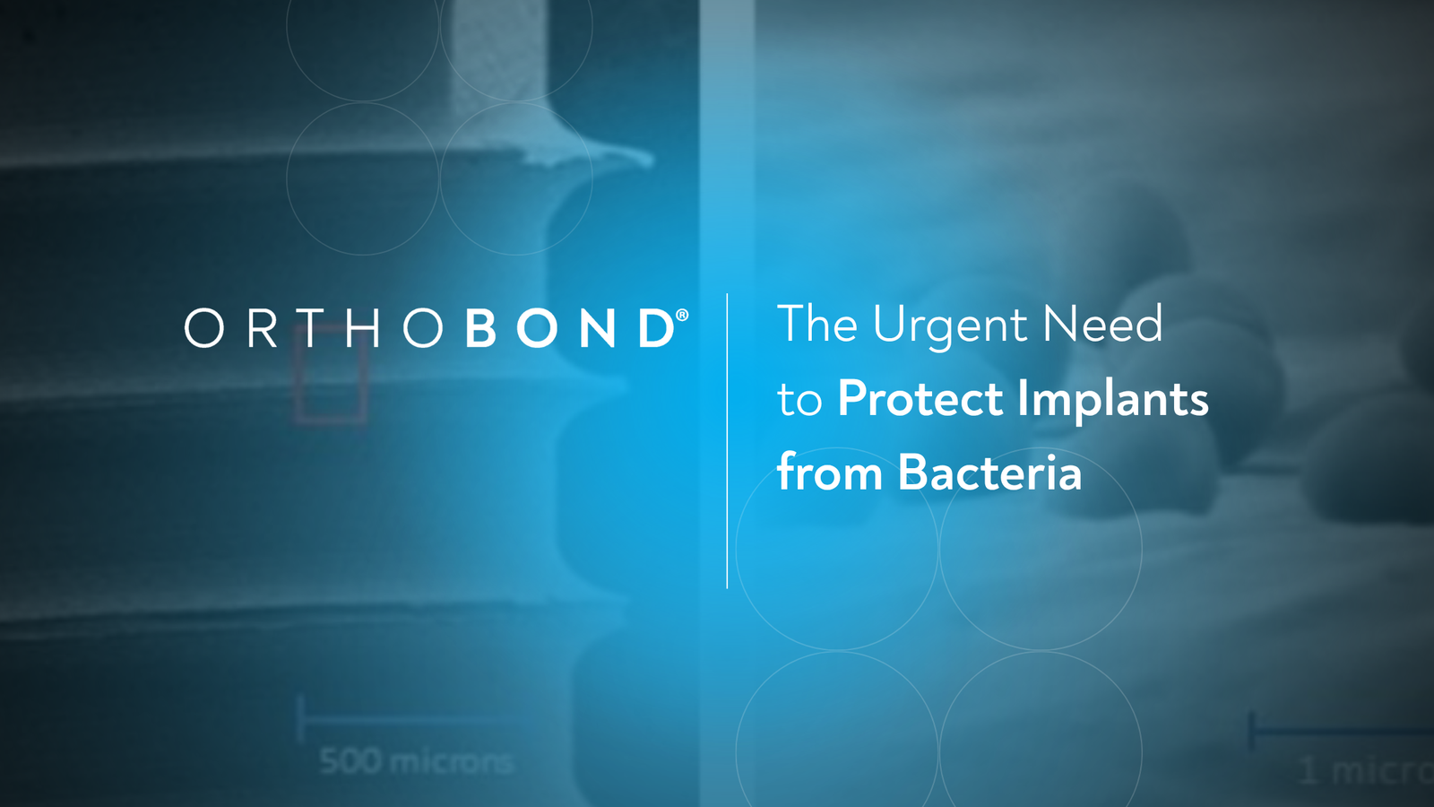 The Urgent Need to Protect Implants from Bacteria: Incidence of DRIs and Occult Infections